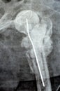 Plain X ray hip joint show left trans cervical fracture of the head of femur with temporary antibiotic loader spacer antibiotic-