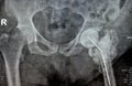 Plain X ray hip joint show left trans cervical fracture of the head of femur with temporary antibiotic loader spacer antibiotic-