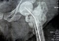 Plain X ray hip joint show left trans cervical fracture of the head of femur with temporary antibiotic loader spacer antibiotic-