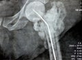 Plain X ray hip joint show left trans cervical fracture of the head of femur with temporary antibiotic loader spacer antibiotic-