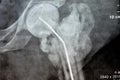 Plain X ray hip joint show left trans cervical fracture of the head of femur with temporary antibiotic loader spacer antibiotic-