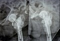 Plain X ray hip joint show left trans cervical fracture of the head of femur with temporary antibiotic loader spacer antibiotic-