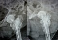 Plain X ray hip joint show left trans cervical fracture of the head of femur with temporary antibiotic loader spacer antibiotic-