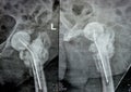 Plain X ray hip joint show left trans cervical fracture of the head of femur with temporary antibiotic loader spacer antibiotic-