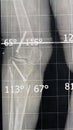 Plain x ray long film standing position showing both legs with bilateral metaphyseal genu varum, previous epiphysiodesis, left Royalty Free Stock Photo