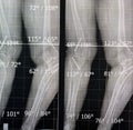 Plain x ray long film standing position showing both legs with bilateral metaphyseal genu varum, previous epiphysiodesis, left Royalty Free Stock Photo