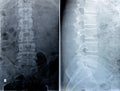 Plain X ray lumbosacral spine revealed straightened, mild scoliotic deformity of lumber spine, spondylotic changes, bilateral
