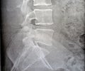 Plain X ray lumbosacral spine revealed straightened, mild scoliotic deformity of lumber spine, spondylotic changes, bilateral