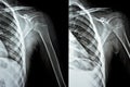 Plain x Ray PXR of left shoulder of skeletally immature female patient child showing lateral one third fracture clavicle, broken