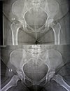 bilateral Avascular necrosis (AVN) of the femoral head more in the left side, a type of aseptic osteonecrosis Royalty Free Stock Photo