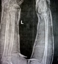 Plain X ray of right forearm (mistakenly written Left on the film) showing fracture of the lower part of ulna in cast