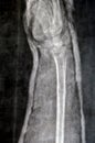 Plain X ray of right forearm (mistakenly written Left on the film) showing fracture of the lower part of ulna in cast