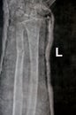 Plain X ray of right forearm (mistakenly written Left on the film) showing fracture of the lower part of ulna in cast