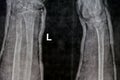 Plain X ray of right forearm (mistakenly written Left on the film) showing fracture of the lower part of ulna in cast