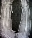 Plain X ray of right forearm (mistakenly written Left on the film) showing fracture of the lower part of ulna