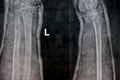 Plain X ray of right forearm (mistakenly written Left on the film) showing fracture of the lower part of ulna