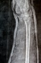 Plain X ray of right forearm (mistakenly written Left on the film) showing fracture of the lower part of ulna