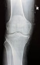 Plain X ray of the right knee shows apparent joint osteoarthritis according to Kellgren and Lawrence system for classification