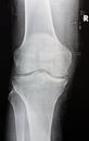 Plain X ray of the right knee shows apparent joint osteoarthritis according to Kellgren and Lawrence system for classification