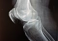 Plain X ray of the right knee shows apparent joint osteoarthritis according to Kellgren and Lawrence system for classification