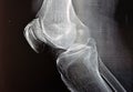 Plain X ray of the right knee shows apparent joint osteoarthritis according to Kellgren and Lawrence system for classification