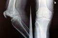 Plain X ray of the right knee shows apparent joint osteoarthritis according to Kellgren and Lawrence system for classification of