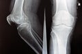 Plain X ray of the right knee shows apparent joint osteoarthritis according to Kellgren and Lawrence system for classification