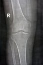 Plain X ray of the right knee shows apparent joint osteoarthritis according to Kellgren and Lawrence system