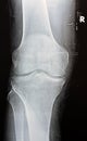 Plain X ray of the right knee shows apparent joint osteoarthritis according to Kellgren and Lawrence system