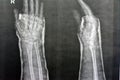 Plain x ray right wrist joint shows right distal radius fracture, closed reduction and cast done, selective focus of x-ray imaging
