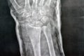 Plain x ray right wrist joint shows right distal radius fracture, closed reduction and cast done, selective focus of x-ray imaging