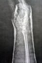 Plain x ray right wrist joint shows right distal radius fracture, closed reduction and cast done, selective focus of x-ray imaging