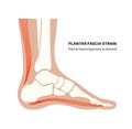 Plantar fascia strain