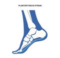 Plantar fascia strain