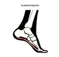 Plantar fasciitis concept