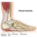 Plantar fasciitis 3d medical  illustration on white background Royalty Free Stock Photo