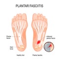 Plantar fasciitis. disorder of the connective tissue which supports the arch of the foot Royalty Free Stock Photo