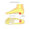 Plantar fasciitis Royalty Free Stock Photo