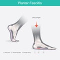 Plantar Fasciitis. Illustration human foot.