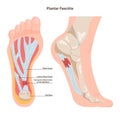 Plantar fasciitis. Plantar fascia inflammation or tearing. Disorder Royalty Free Stock Photo