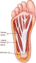 Plantar fascitis illustration