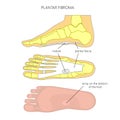 Plantar fibroma Royalty Free Stock Photo