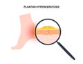 Plantar hyperhidrosis poster