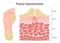 Plantar hyperkeratosis. Feet corns and calluses, medical condition