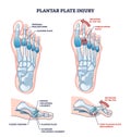 Plantar plate injury anatomy and foot capsule torn trauma outline diagram.