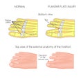 Plantar plate tear. Deviation of the toe