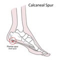 Plantar spur calcaneal spur. Human foot bones. Illustration Isolated on a white background