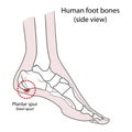 Plantar spur calcaneal spur. Human foot bones. illustration Isolated on a white background