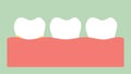 Plaque on gum before gingivitis or gum disease