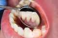 Plaque of the patient, stone. Dentistry treatment of dental plaque, professional oral hygiene. The concept of harm to smoking and